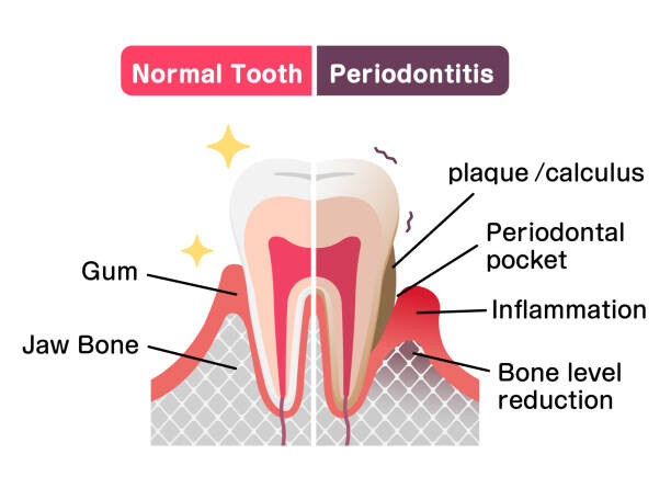 Quadro em tela Comparison of normal teeth and periodontal